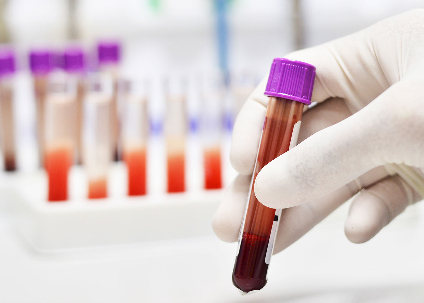 Leukemia：IL-6跨信號(hào)對(duì)CAR-T細(xì)胞抗腫瘤作用機(jī)制
